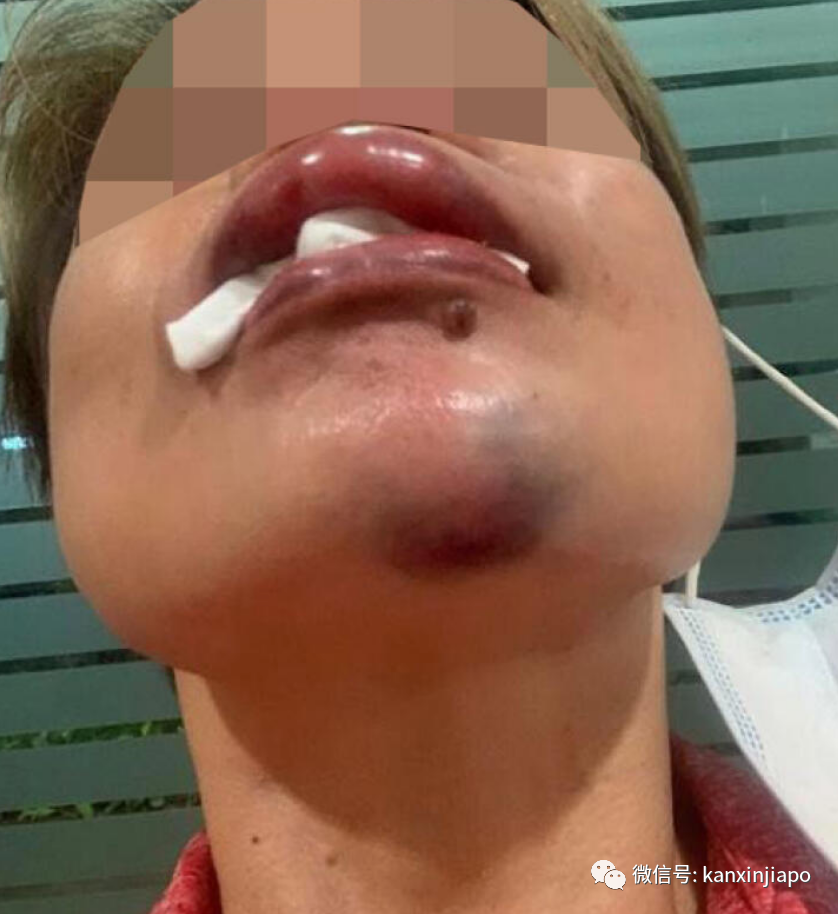 因爲拍攝不戴口罩聚賭，新加坡女經理被揍到臉頰骨折